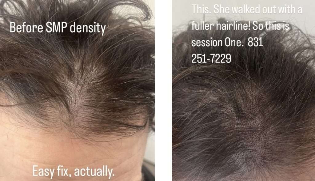 Hair Follicle Tattoo SMP Density Fill